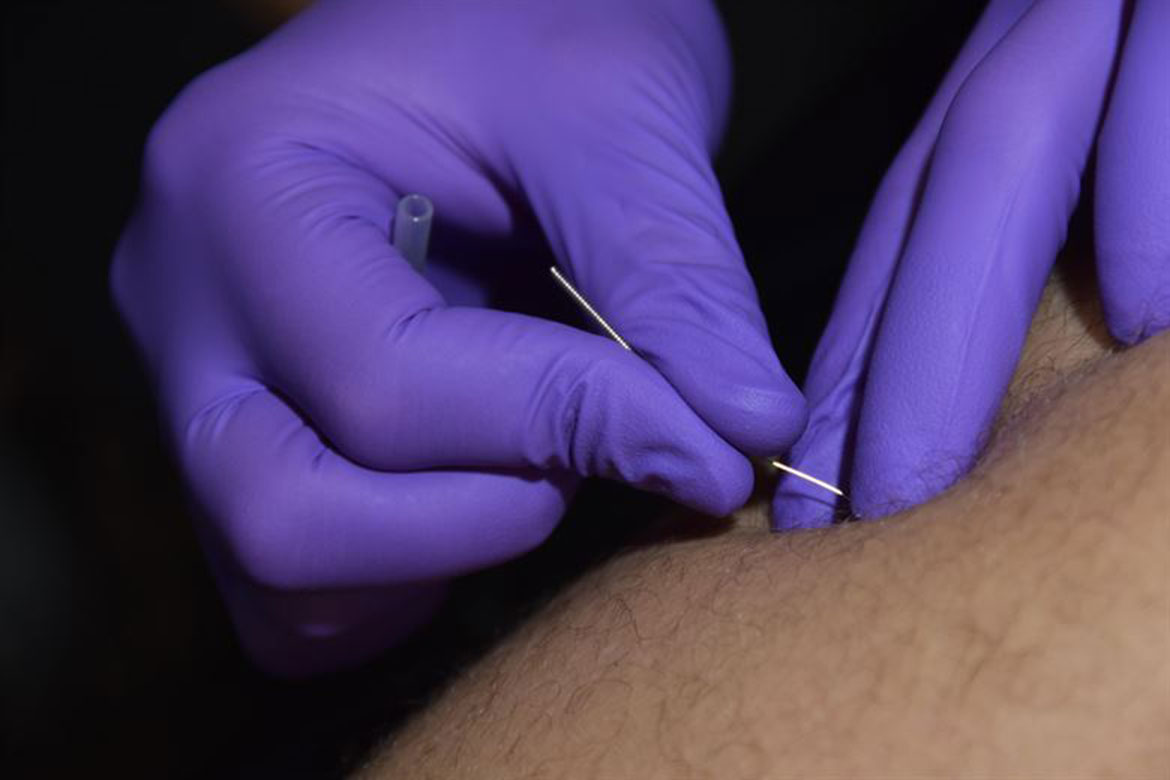 Dry Needling